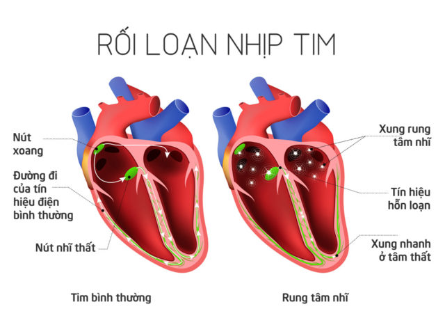 Loạn nhịp tim là biểu hiện hội chứng mạch vành cấp có ST chênh lên